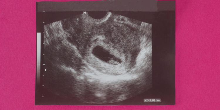 Aborto