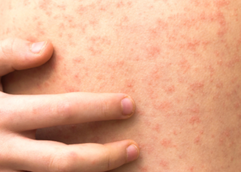 La CDC advierte sobre brotes de sarampión en San Diego