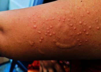 Detectan en California primer caso de Mpox
