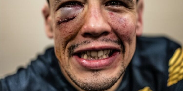 Así quedó el rostro de Brandon Moreno tras su victoria este sábado.