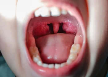 La faringitis estreptocócica está en aumento en los Estados Unidos