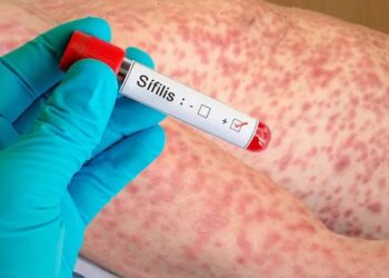 Casos de sífilis aumentan dramáticamente en EUA, alcanzando cifras no vistas desde 1950