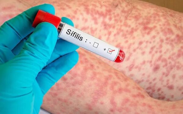 Casos de sífilis aumentan dramáticamente en EUA, alcanzando cifras no vistas desde 1950