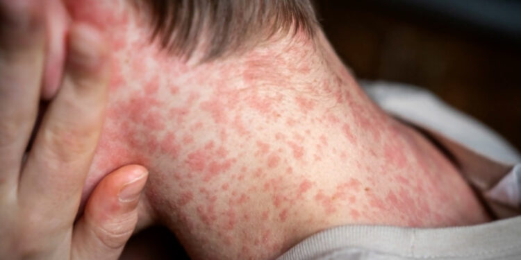 Autoridades comparten recomendaciones para evitar el sarampión en las vacaciones de primavera