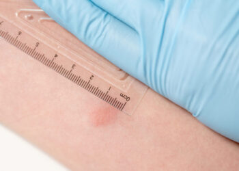 Alerta por posible exposición a tuberculosis en escuela de San Ysidro