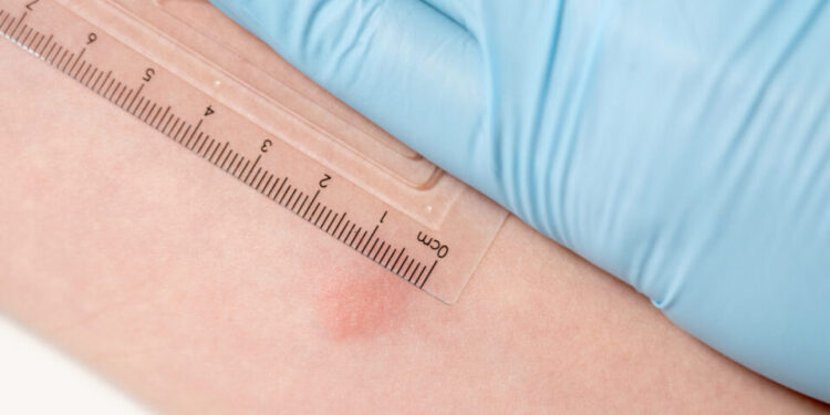 Alerta por posible exposición a tuberculosis en escuela de San Ysidro