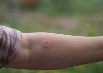 IMSS alerta por picaduras y mordeduras en verano