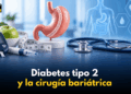 Diabetes tipo 2 y cirugía bariátrica: más allá de la pérdida de peso | KSDY AM